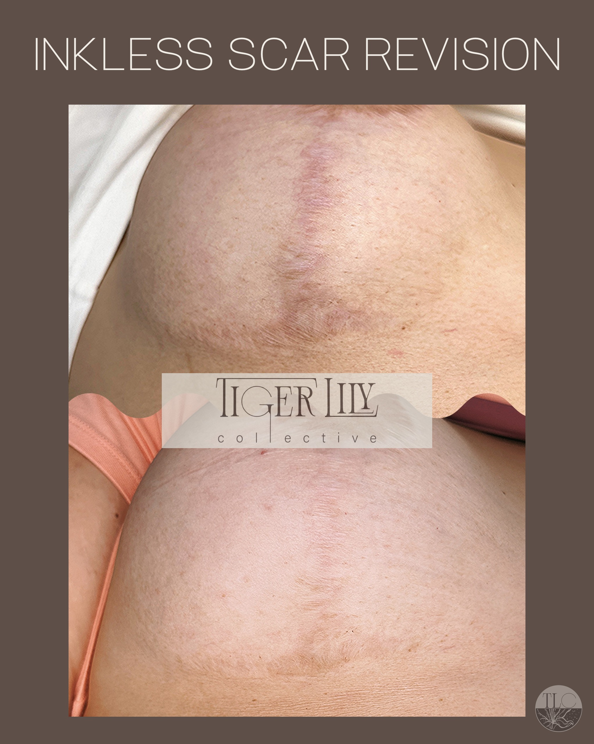 Inkless Scar Revision: How Collagen Stimulating Serum Heals Your Skin Naturally