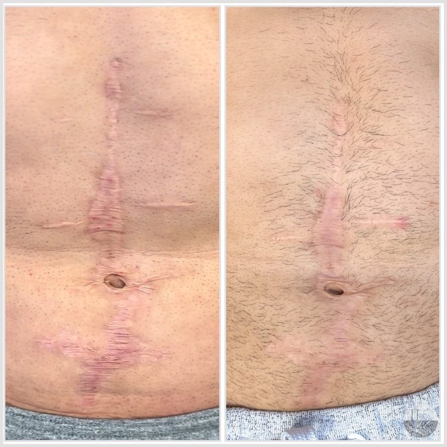 Inkless Scar Revision: How Your Body Heals Itself with Paramedical Tattooing